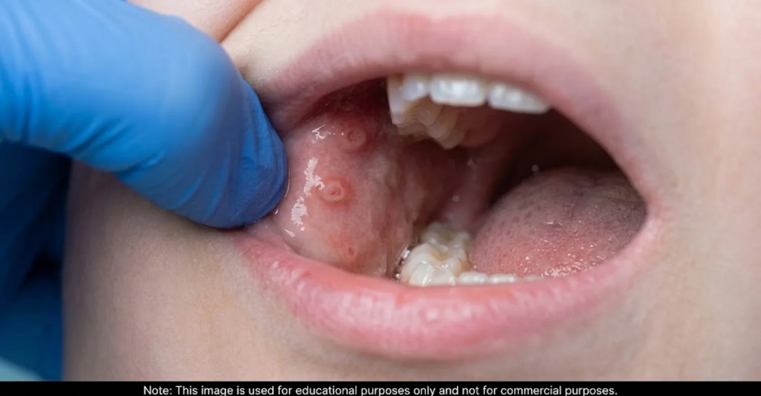 Chickenpox in Mouth Dangerous 2